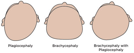Plagiocephaly, Brachycephaly, Brachycephaly with Plagiocephaly